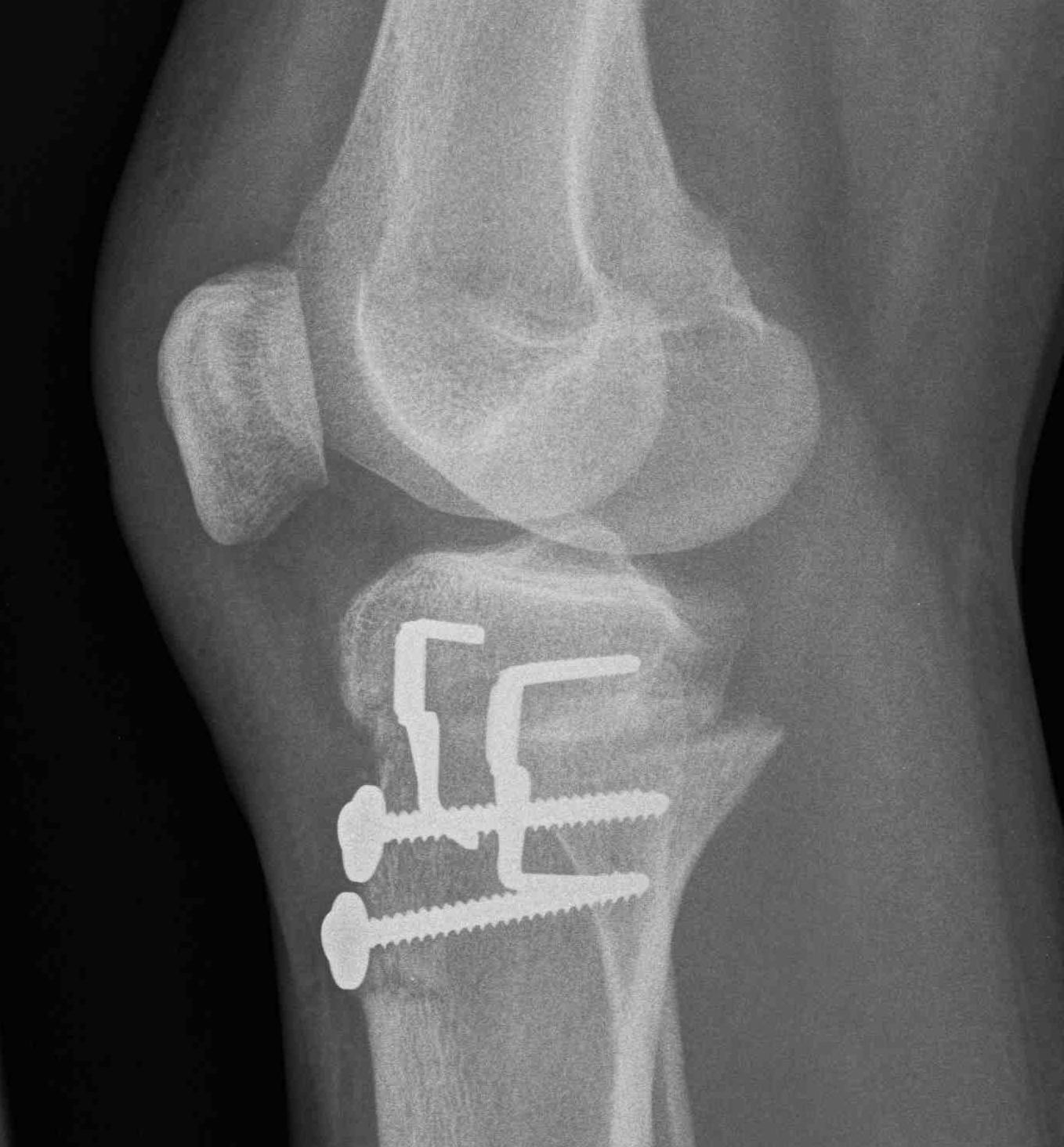 Tibial Derotation Osteotomy Lateral